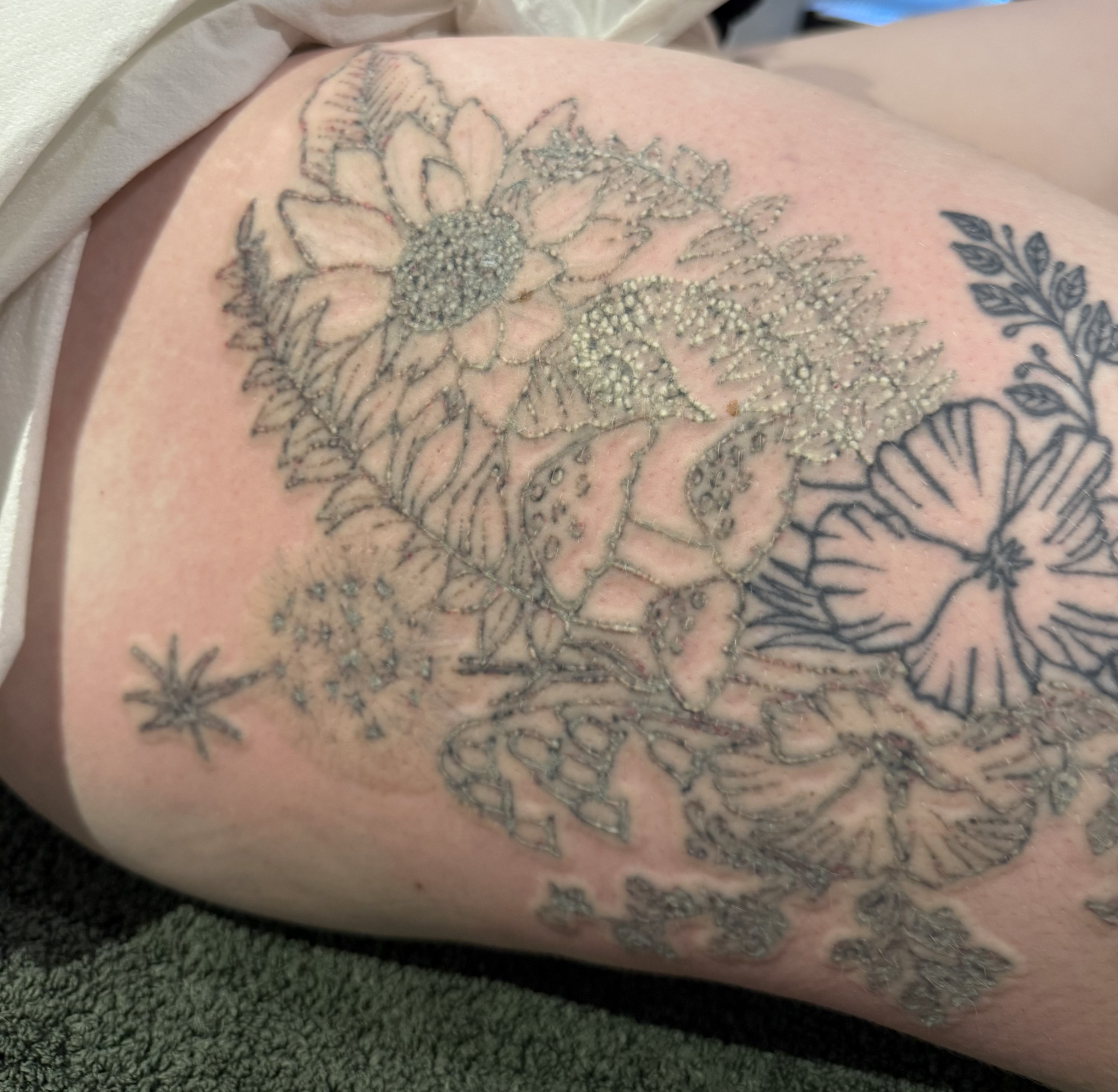 Tattoo immediately after the first laser tattoo removal session showing frosting