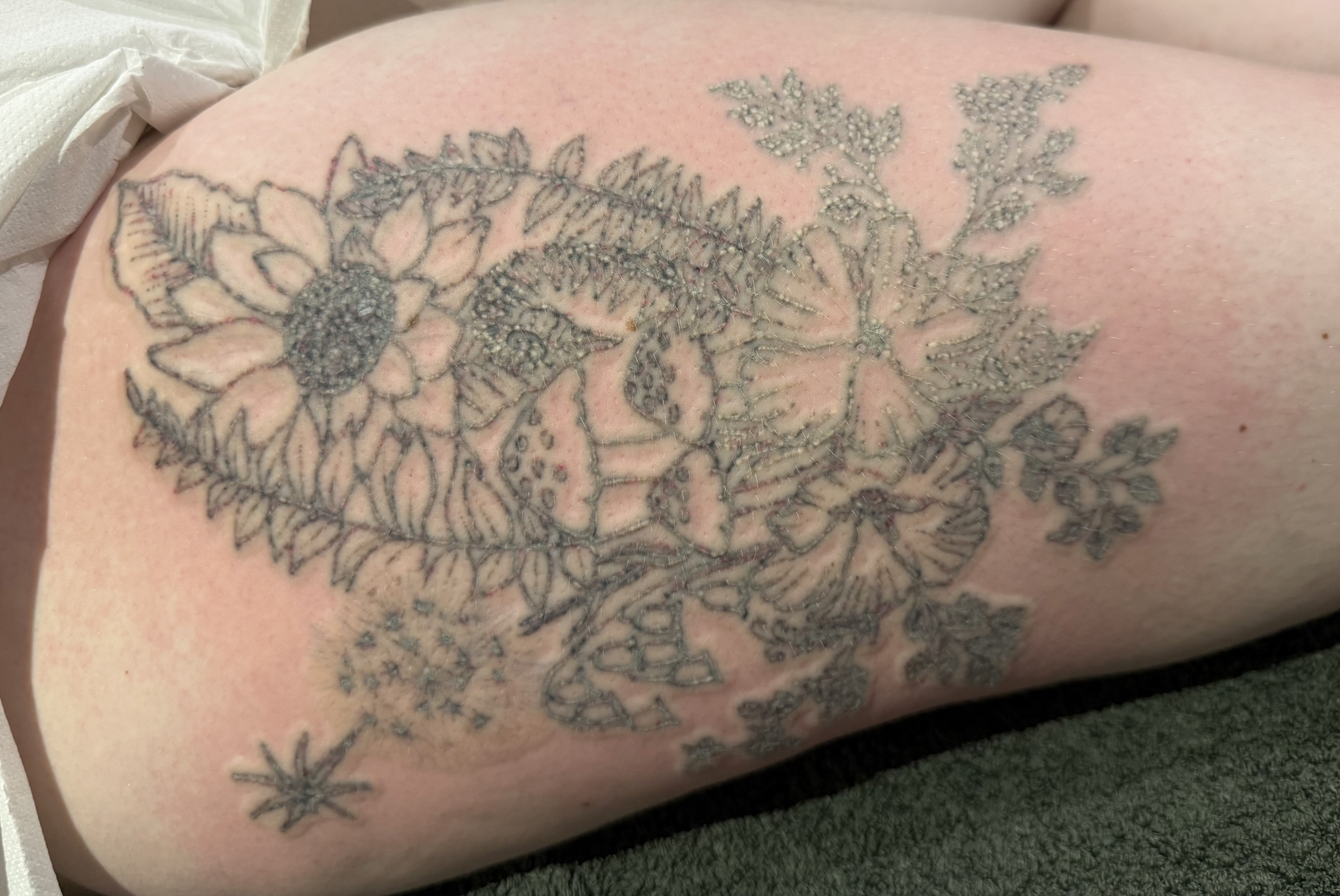 Tattoo immediately after the first laser tattoo removal session from another angle